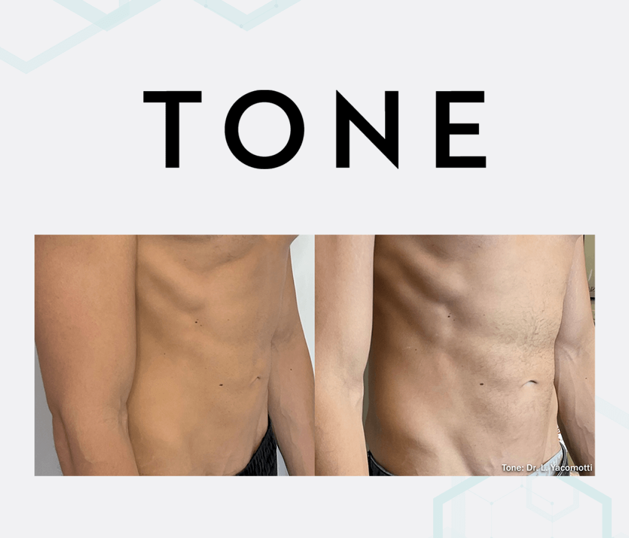 muscle toning South Florida